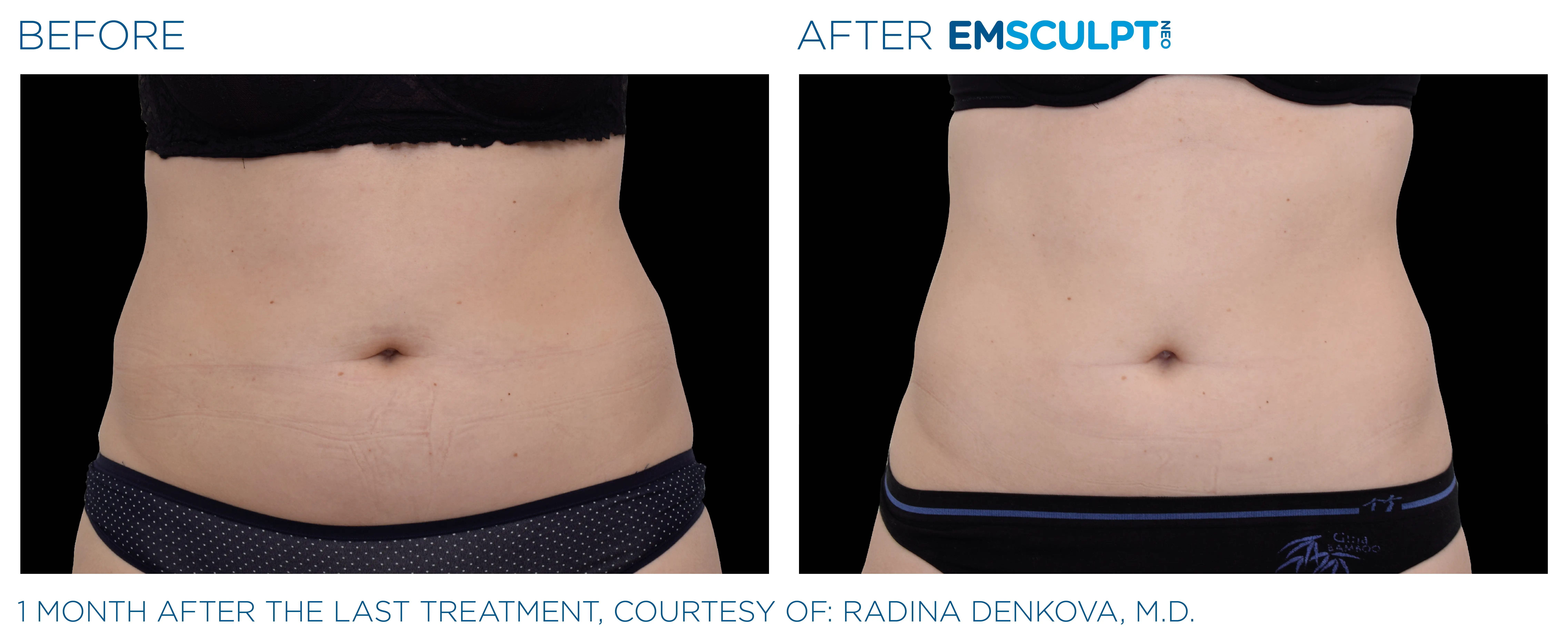 Emsculpt Neo before and after abdomen result showing a flatter, more defined core.