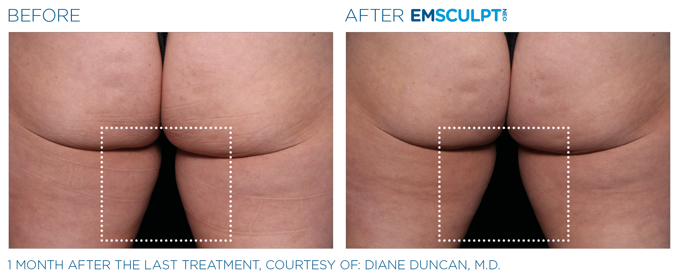 Emsculpt Neo thighs before and after