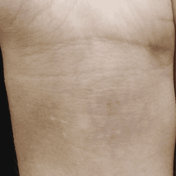 Tattoo after Cutera Enlighten III treatment series.