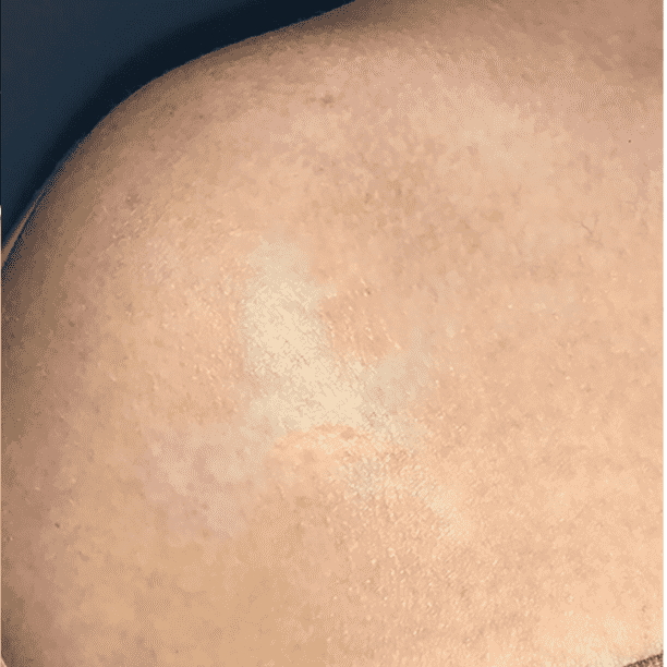 Tattoo after Cutera Enlighten III treatment series.