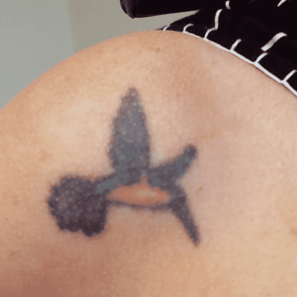 Tattoo before Cutera Enlighten III treatment.