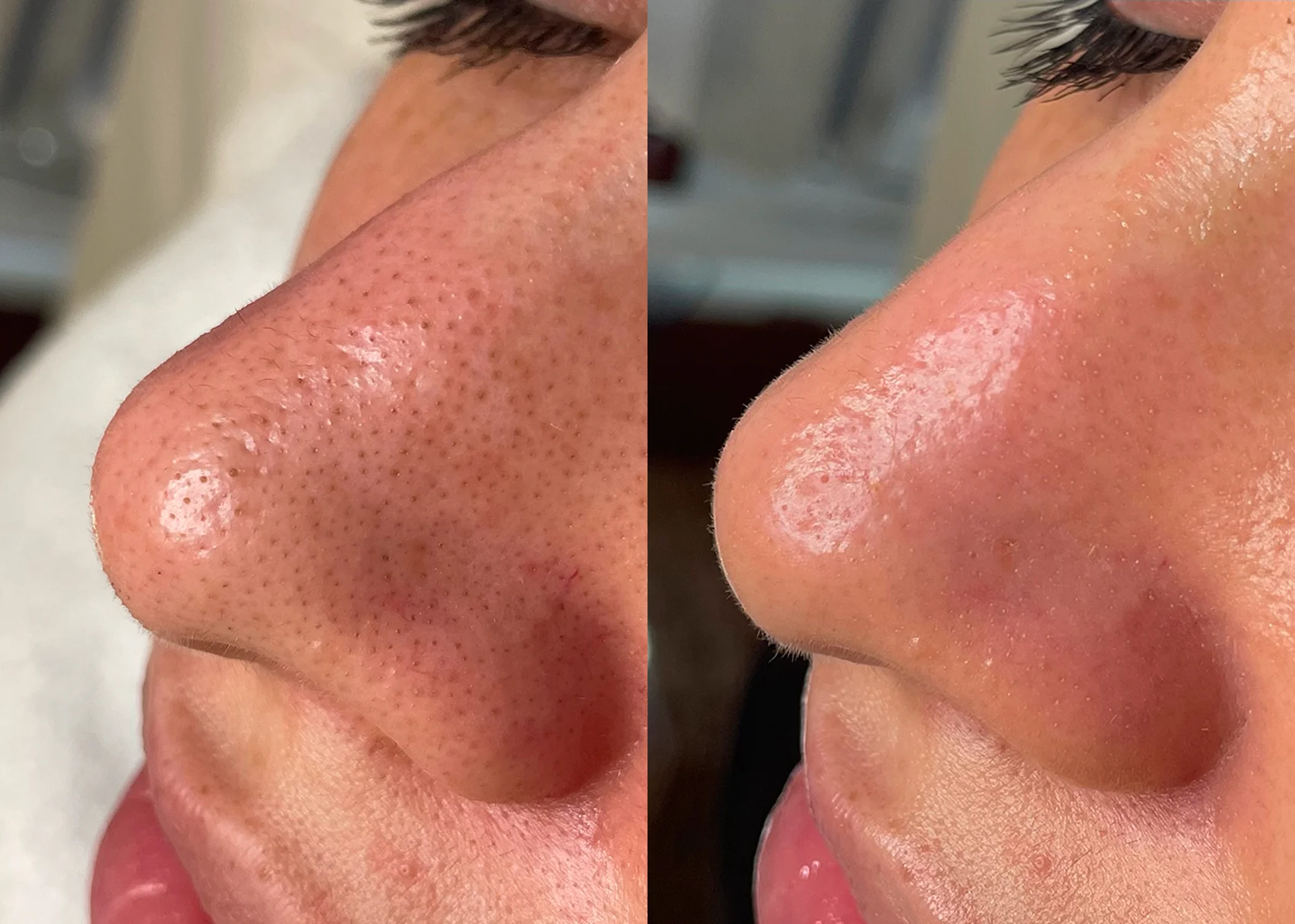 HydraFacial before and after result showing clearer pores and brighter cheek texture.