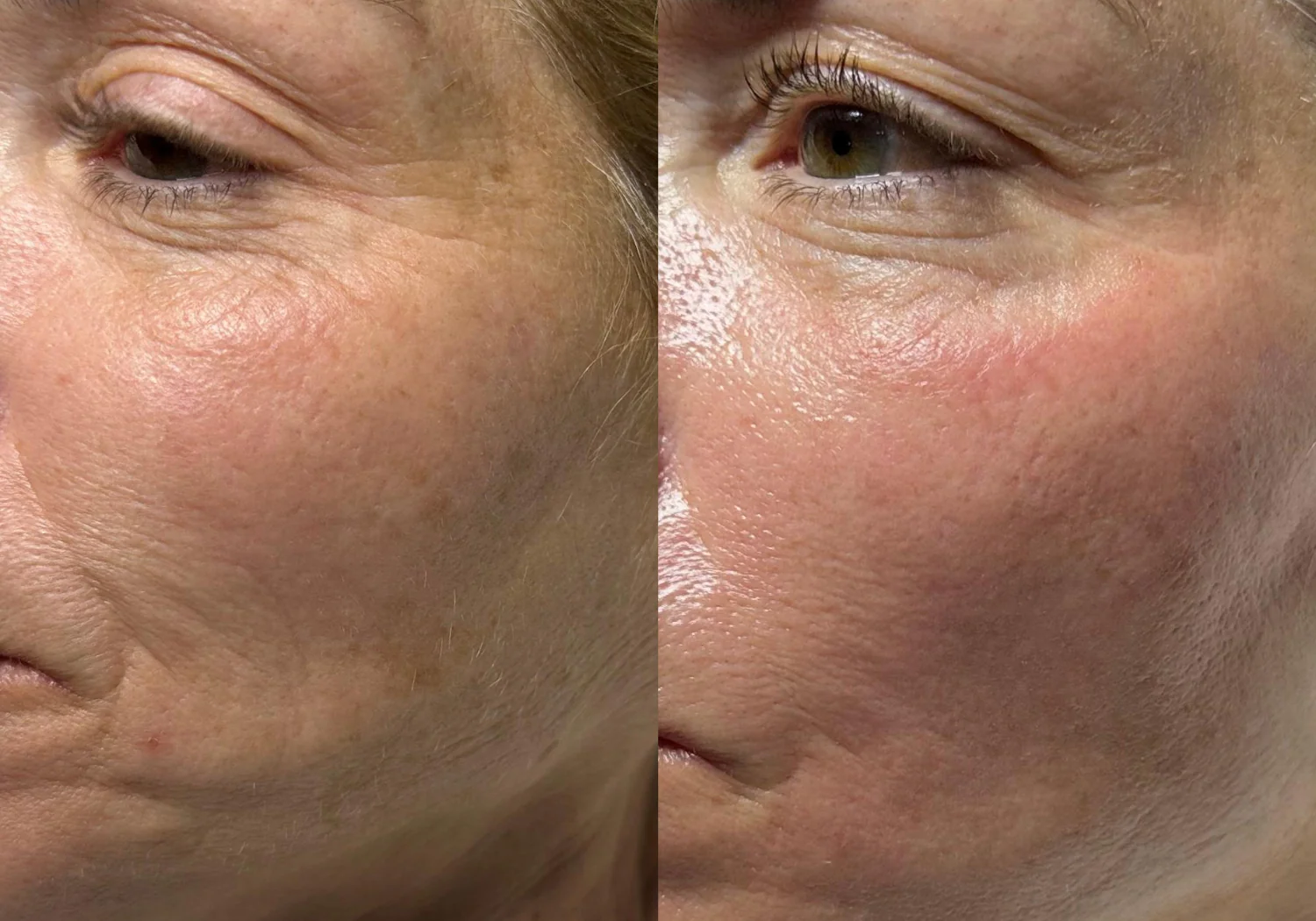 HydraFacial before and after result showing smoother texture around the eye and cheek area.