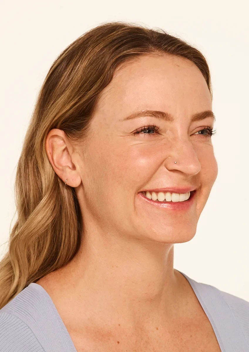 Mandy before Botox treatment — visible crow's feet
