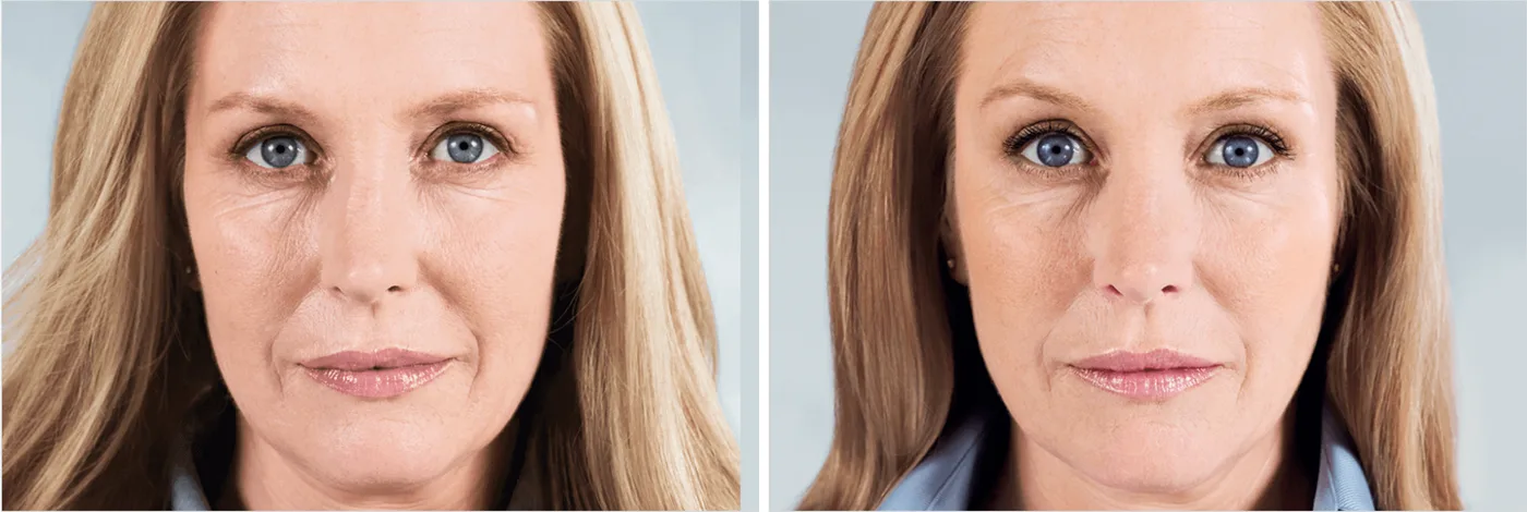 Sculptra vs. Dermal Fillers: Which Is Right for Your Face?