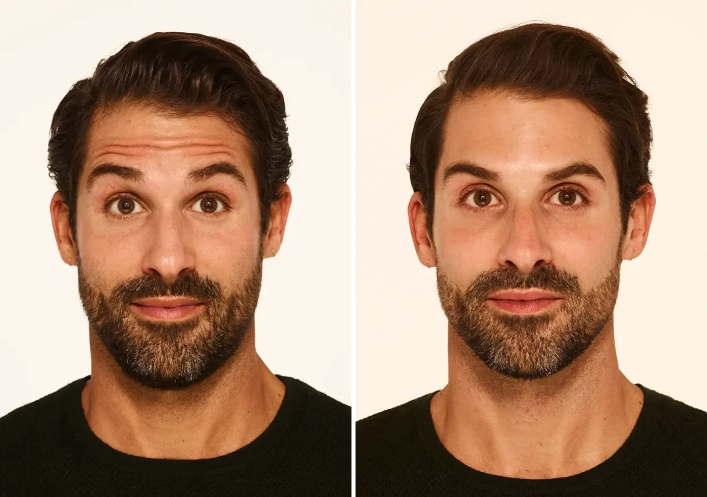 How Long Do Wrinkle Relaxers Last? A Realistic Timeline from a Brickell Injector