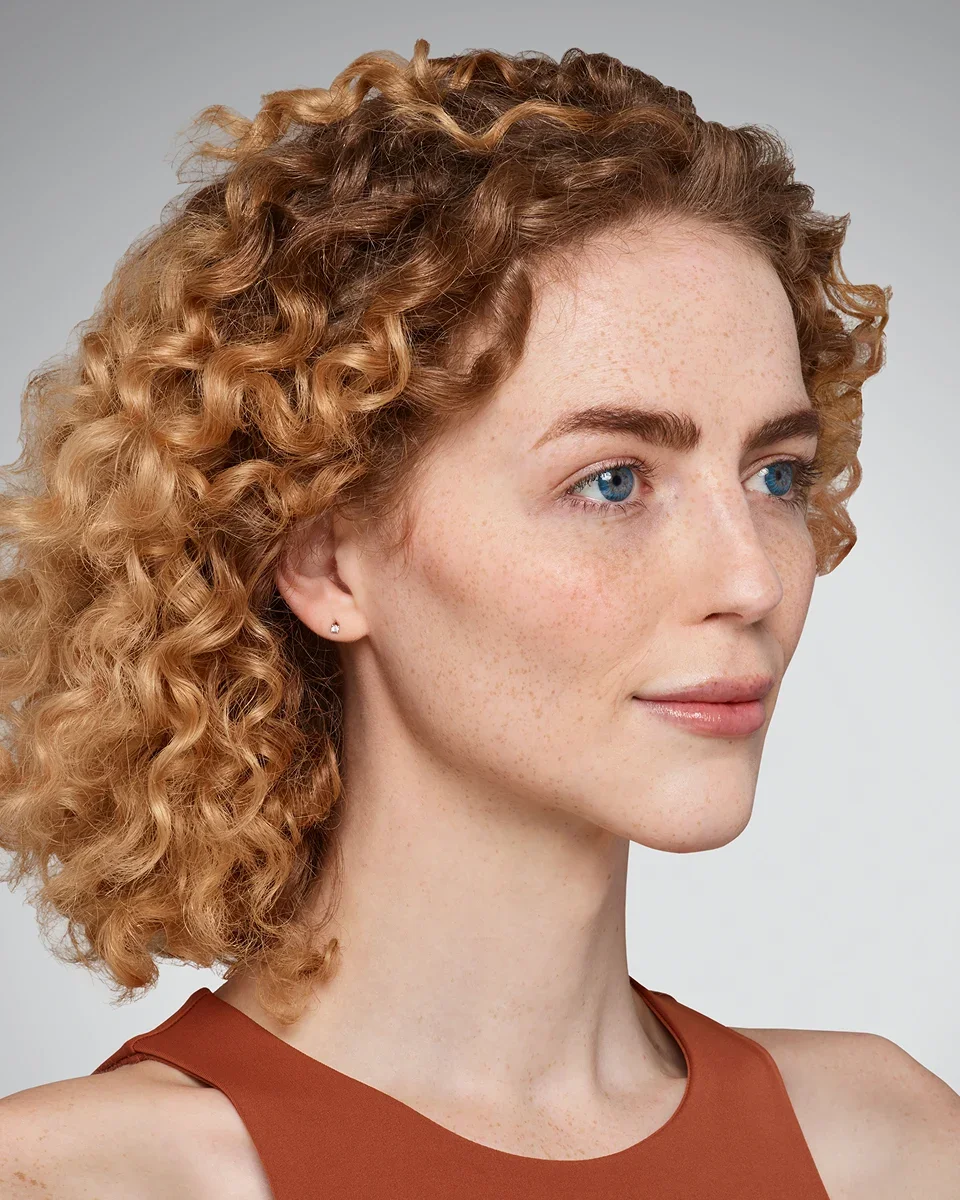 Addieson after Juvéderm Voluma cheek and chin contour