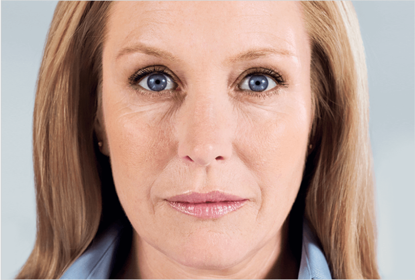 Sculptra biostimulator results — gradual collagen restoration over months on a Miami Skin Spa patient Sculptra biostimulator results — gradual collagen restoration over months on a Miami Skin Spa patient