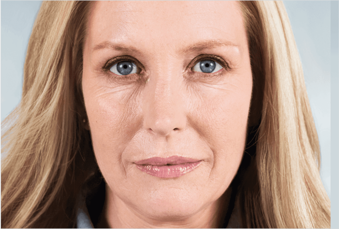 Elissa before Sculptra collagen treatment