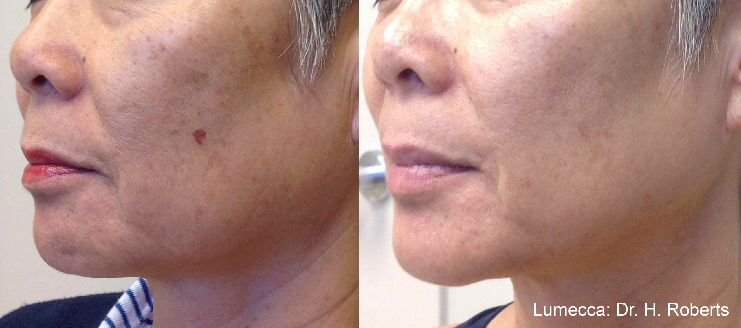 Lumecca IPL before and after result showing improved pigmentation along the cheek and jawline.