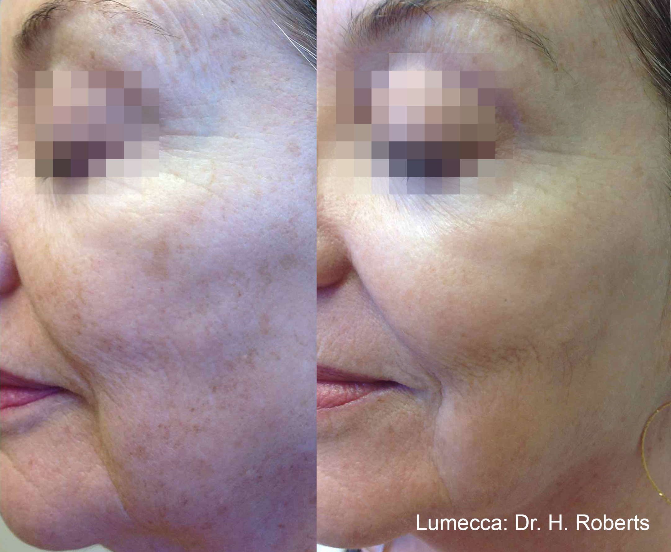Lumecca IPL before and after cheek result showing more even tone.
