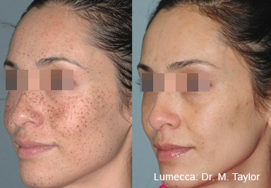 Lumecca IPL before and after result showing improvement in tone and texture on the lower cheek.
