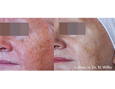 Lumecca IPL before and after result focused on cheek discoloration.
