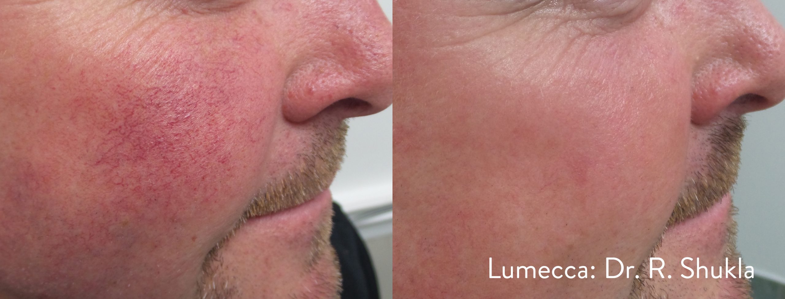 Lumecca IPL before and after result showing reduced sun spots across the cheek and temple.