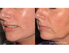 Lumecca IPL before and after case showing smoother-looking tone and reduced discoloration.