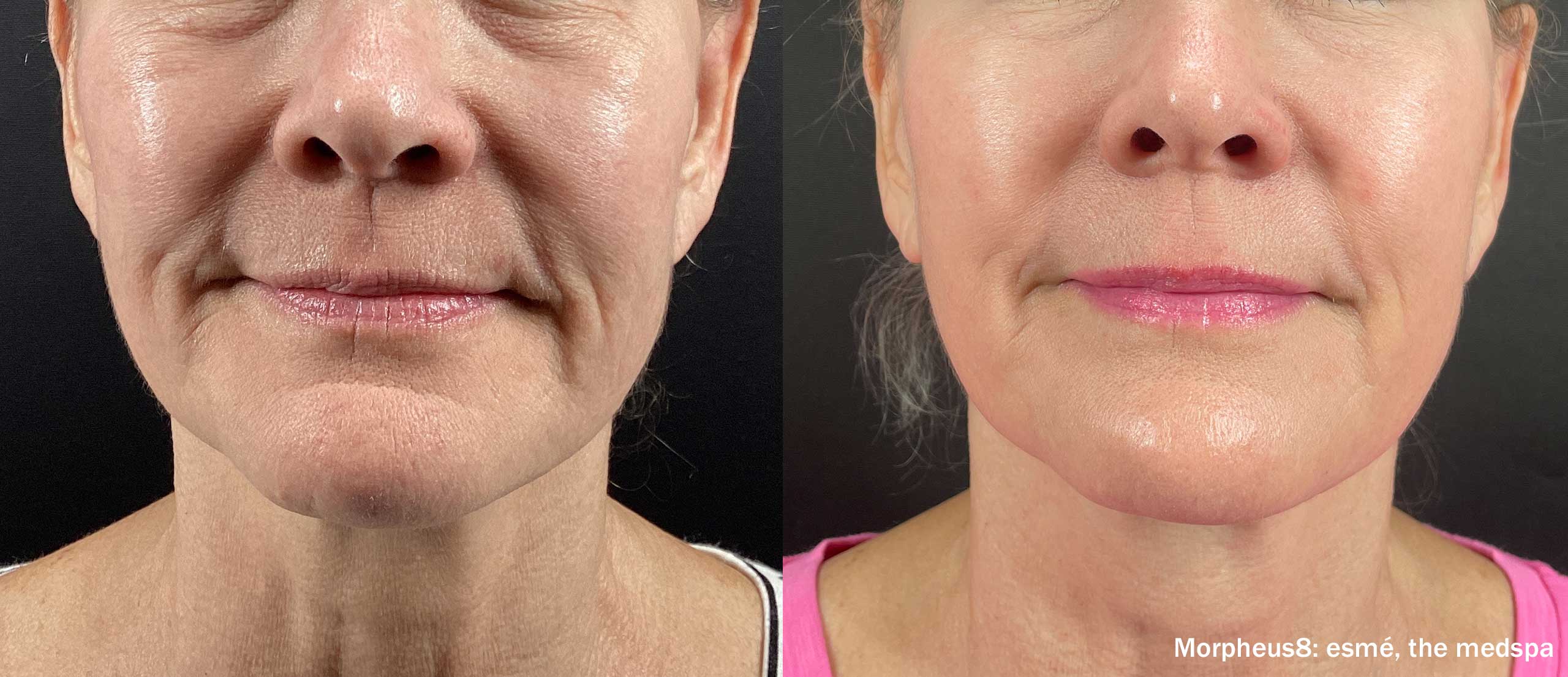 Morpheus8 before and after front-view result showing improvement through the lower face and neck.