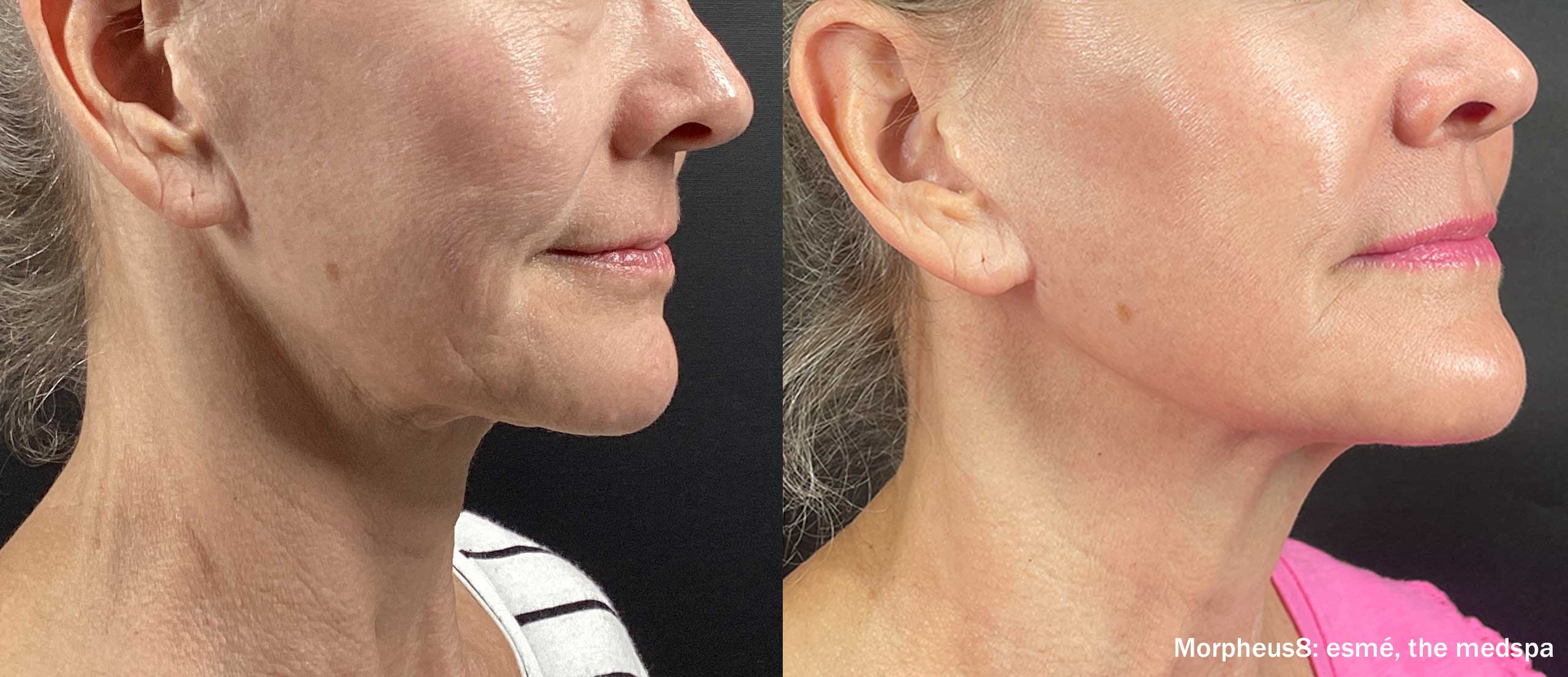 Morpheus8 before and after side-view result showing smoother texture and improved jawline definition.