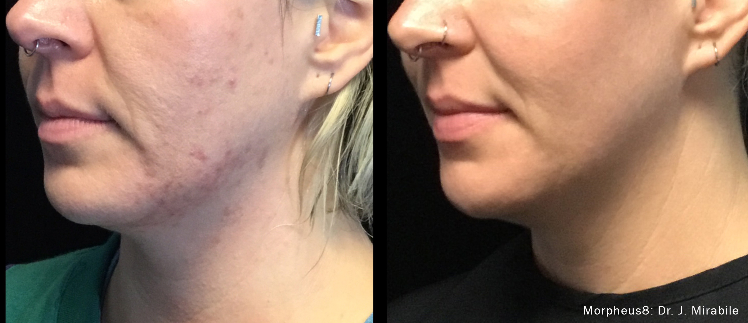 Morpheus8 before and after comparison focused on the chin and upper neck.