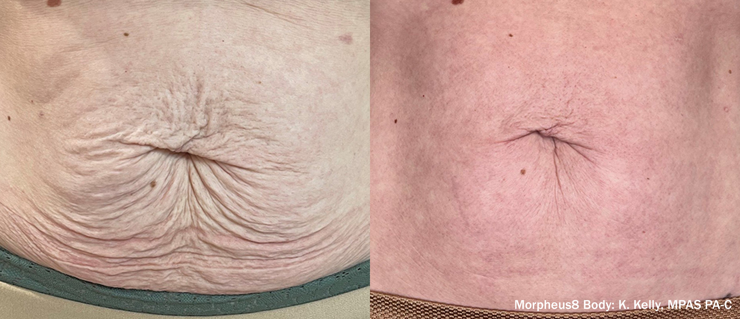Morpheus8 body before and after result showing improved abdominal skin texture.