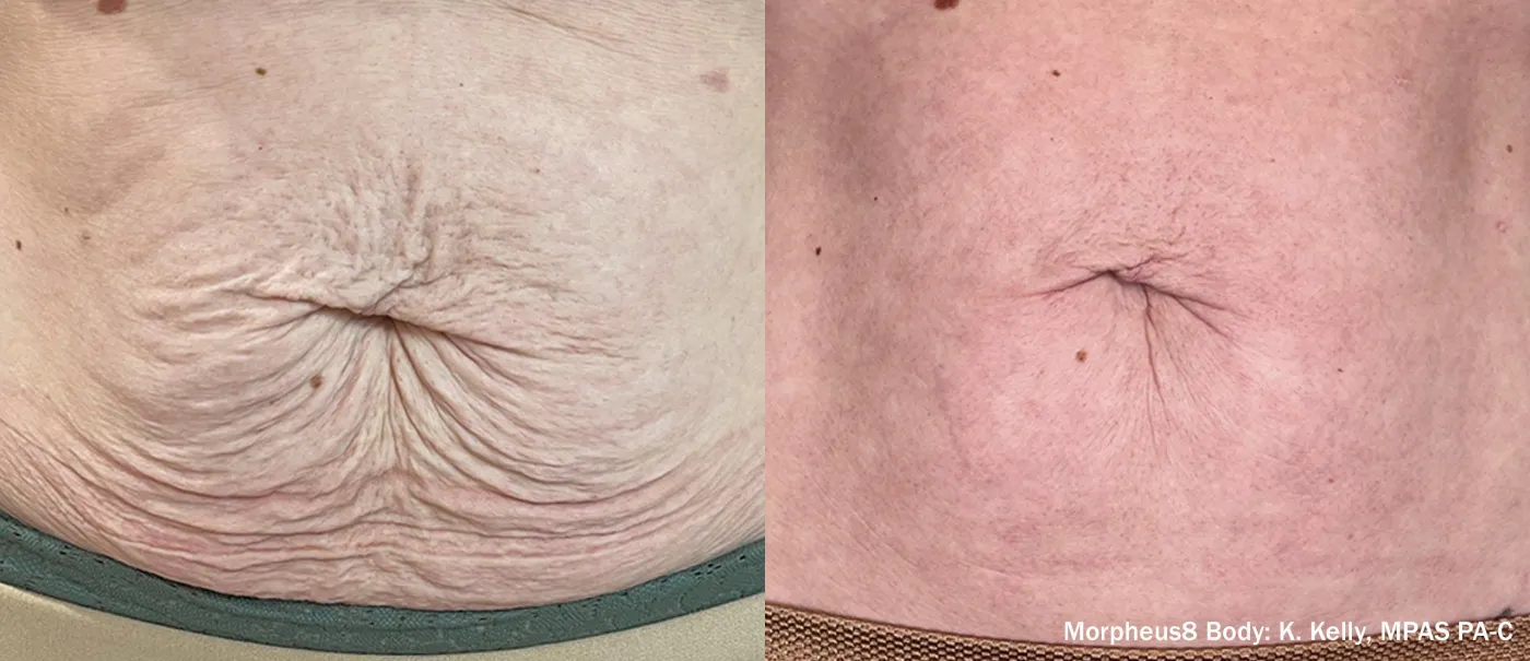 Morpheus8 Body before and after result showing improved abdominal skin texture.