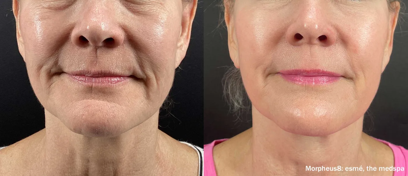 Morpheus8 before and after front-view result showing improvement through the lower face and neck.