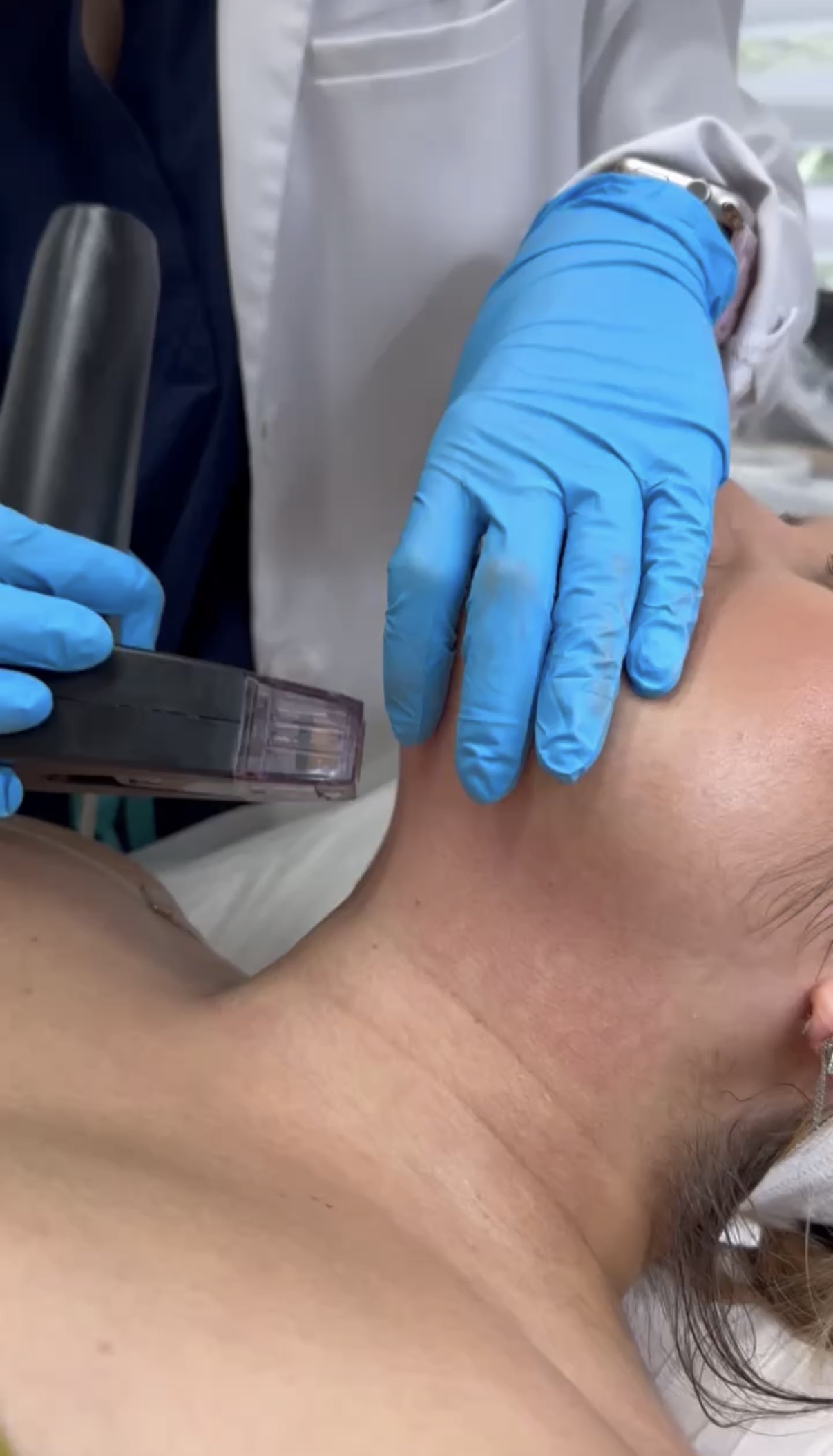 Radiofrequency microneedling handpiece treating the neck during a session at Miami Skin Spa in Brickell, Miami