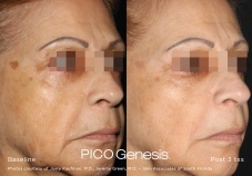 Pico Genesis before and after comparison showing lighter pigment on the cheek after treatment.
