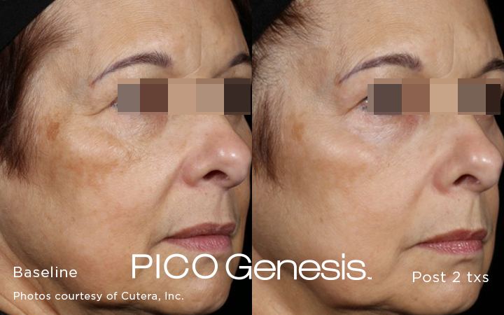Pico Genesis before and after cheek result showing reduced dark spots.