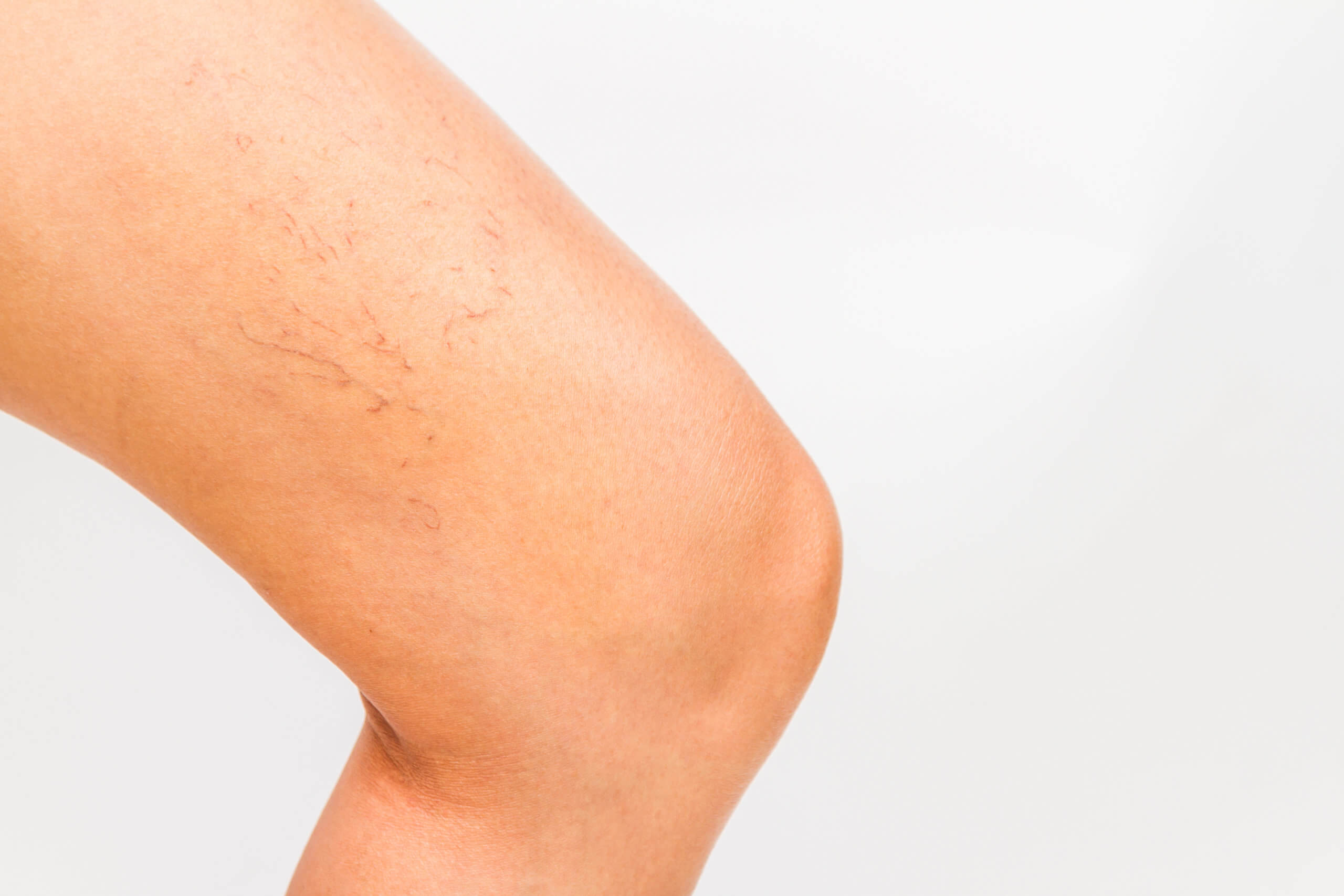 Sclerotherapy Miami Sclerotherapy at Miami Skin Spa in Brickell — minimally invasive spider vein treatment