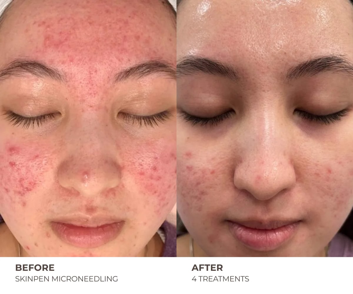 SkinPen microneedling clinical photo — widespread facial redness and breakouts before treatment and after four treatments