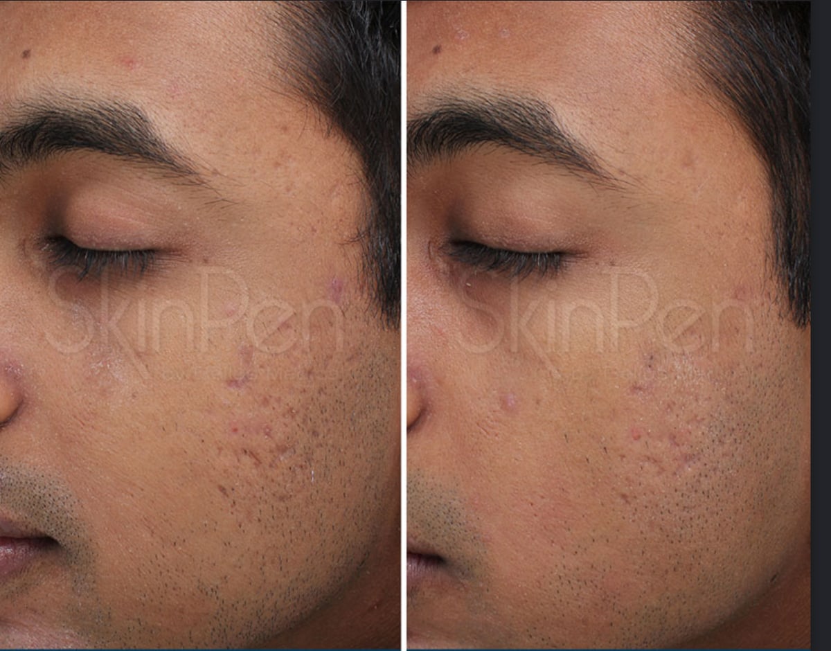SkinPen microneedling clinical photo — acne scarring along the cheek and temple before and after a treatment series