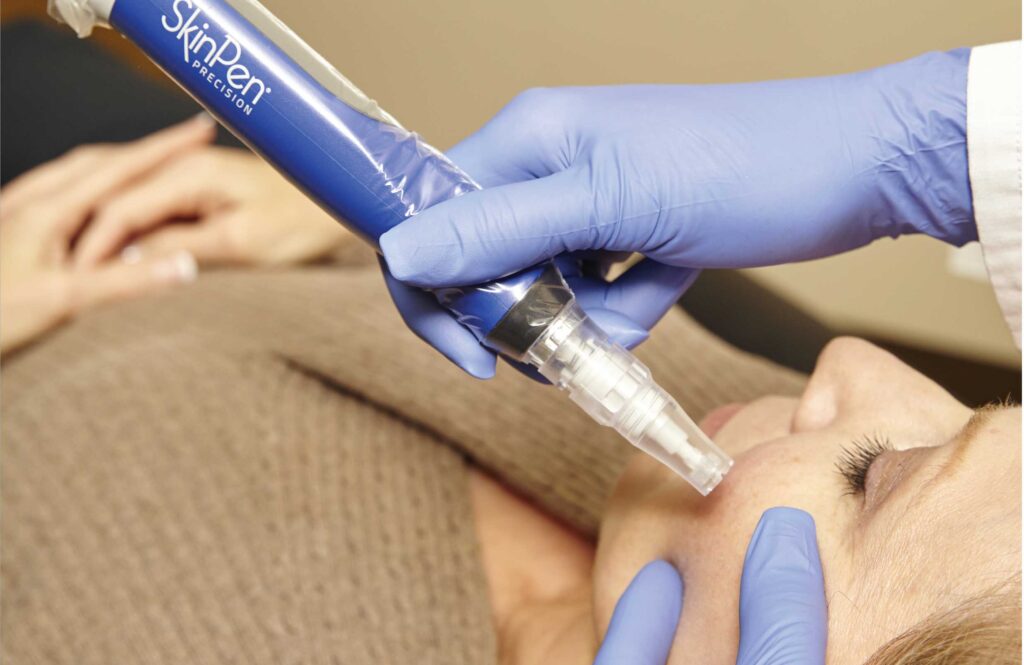 SkinPen microneedling at Miami Skin Spa in Brickell — FDA-cleared device for collagen renewal