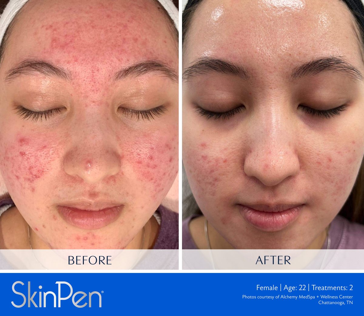 SkinPen microneedling clinical photo — inflammatory acne across the cheeks and forehead before treatment and after two treatments