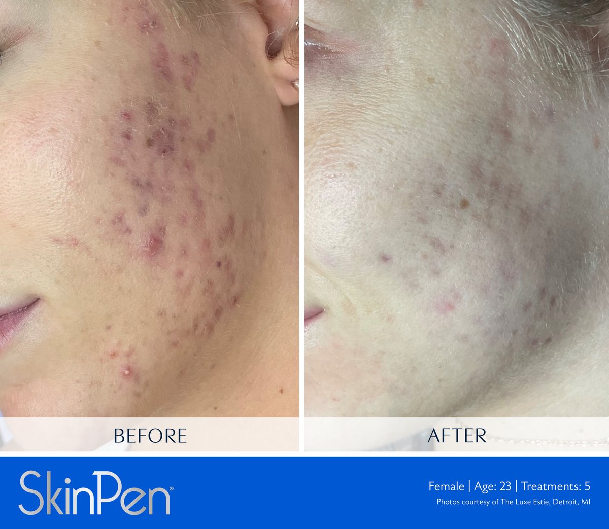 SkinPen microneedling clinical photo — acne scarring and raised lesions along the jaw before treatment and after five treatments