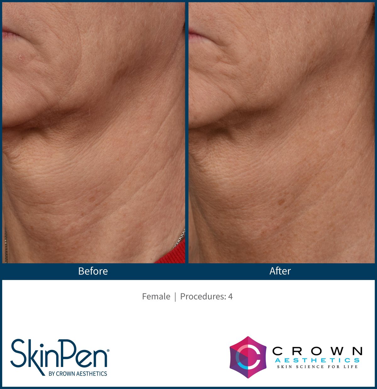 SkinPen microneedling clinical photo — crepey skin along the jawline and upper neck before treatment and after four treatments