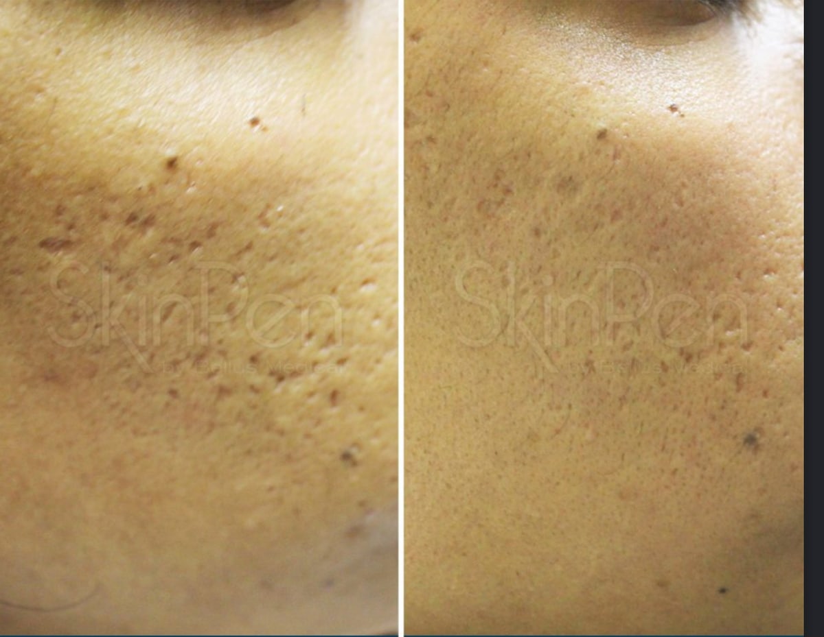 SkinPen microneedling clinical photo — close-up of enlarged pores and uneven skin texture before and after a treatment series