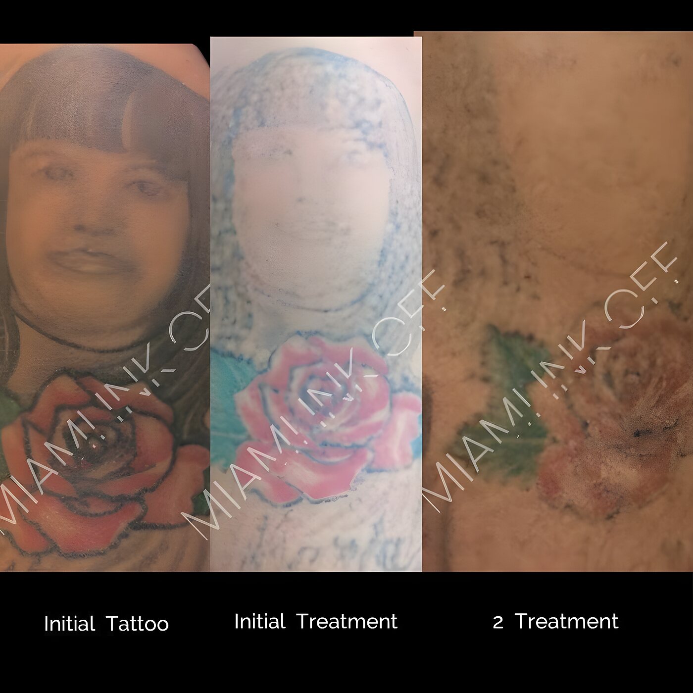 Color portrait and rose upper-arm tattoo faded after two laser tattoo removal sessions at Miami Ink Off, Brickell.
