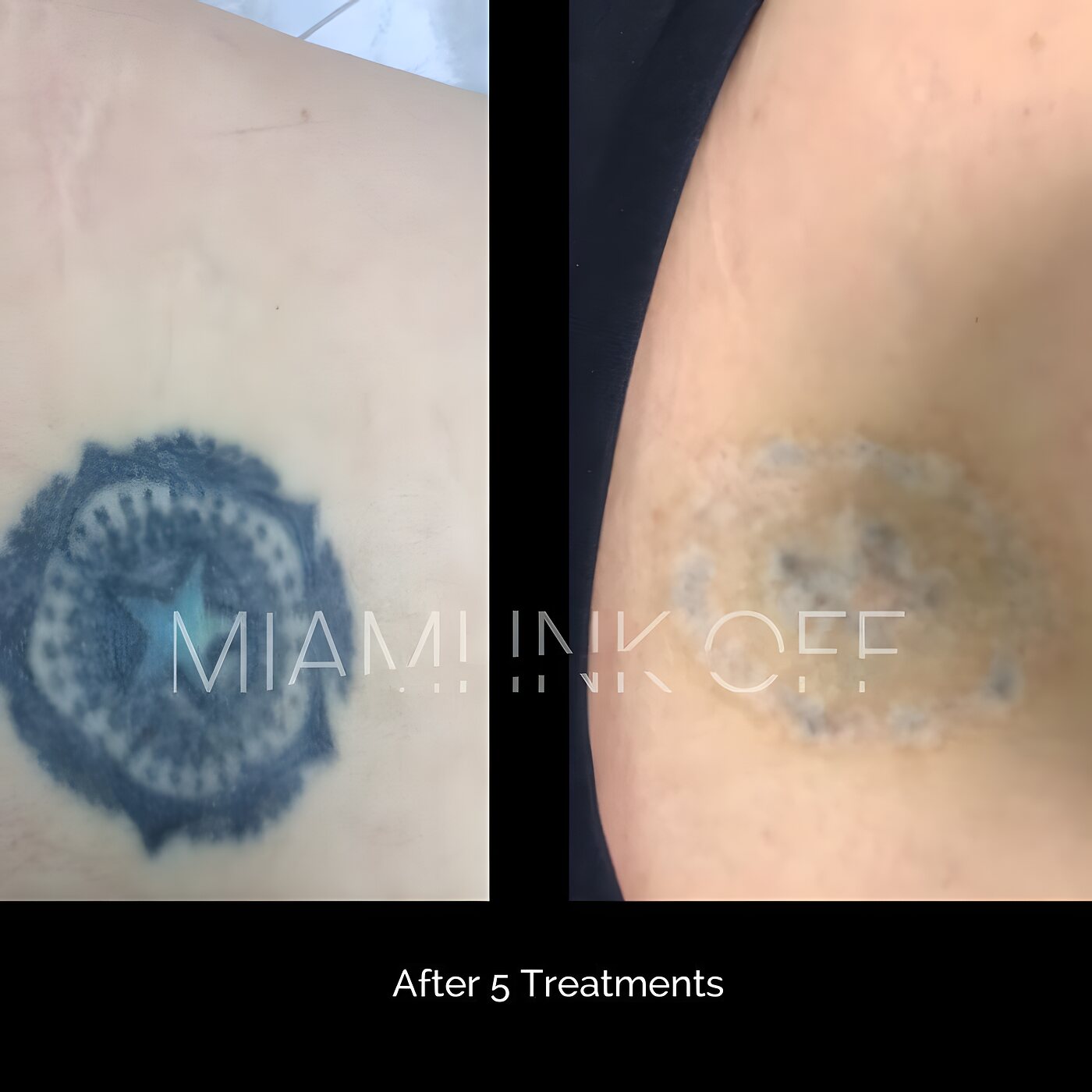 Star medallion upper-arm tattoo strongly faded after five laser tattoo removal sessions at Miami Ink Off, Brickell.