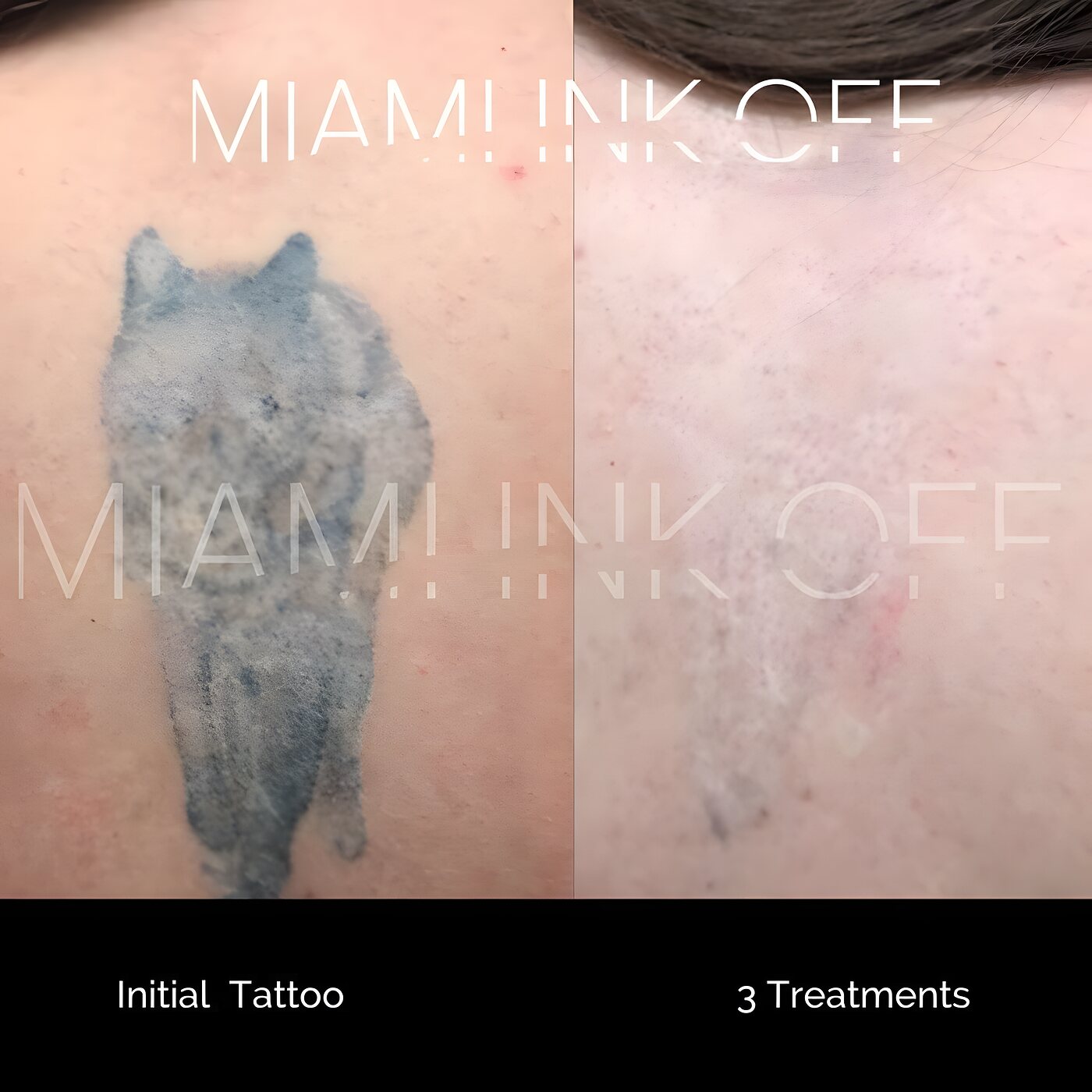 Blue-grey wolf back tattoo dramatically faded after three laser tattoo removal sessions at Miami Ink Off, Brickell.