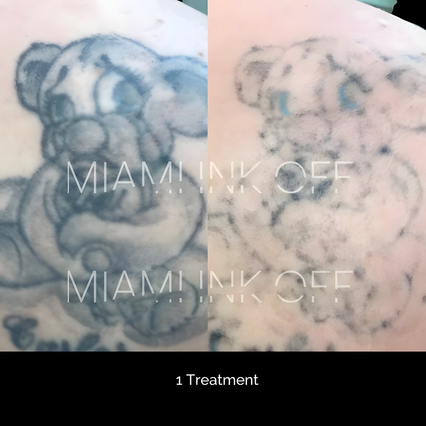 Large cartoon back tattoo significantly faded after one laser tattoo removal session at Miami Ink Off, Brickell.
