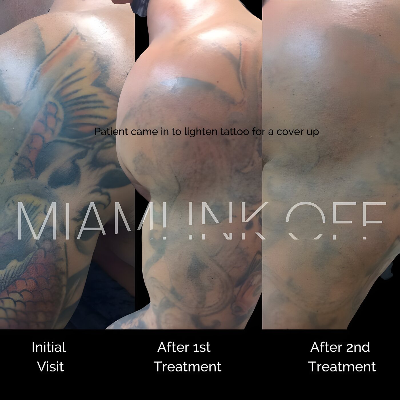Color koi sleeve tattoo lightened over two laser sessions for cover-up at Miami Ink Off, Brickell.