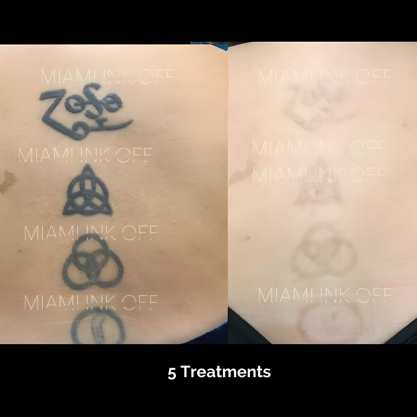 Stacked symbol tattoos on the upper back faded after five laser tattoo removal sessions at Miami Ink Off, Brickell.