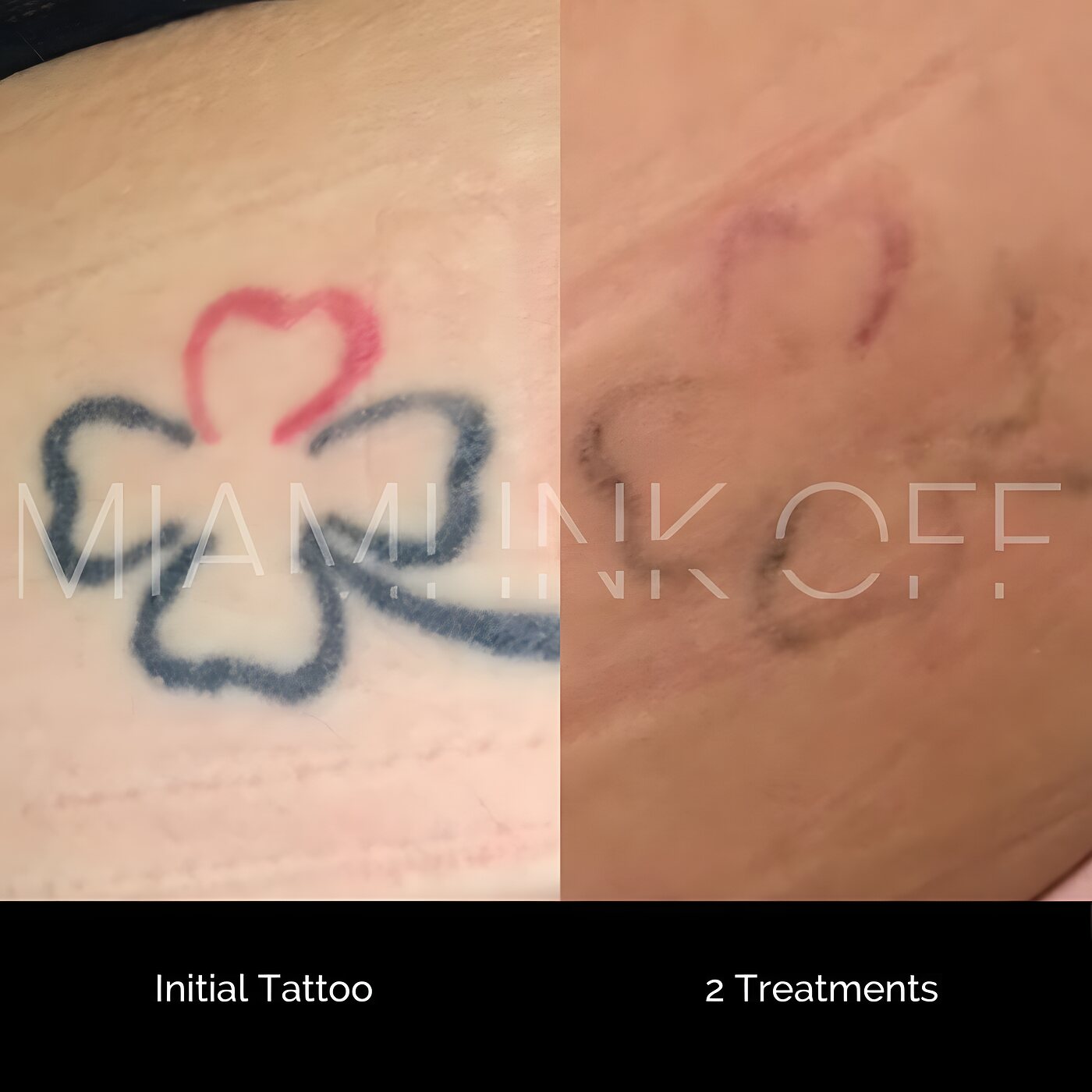 Small color clover-and-heart tattoo fading after two laser tattoo removal sessions at Miami Ink Off, Brickell.