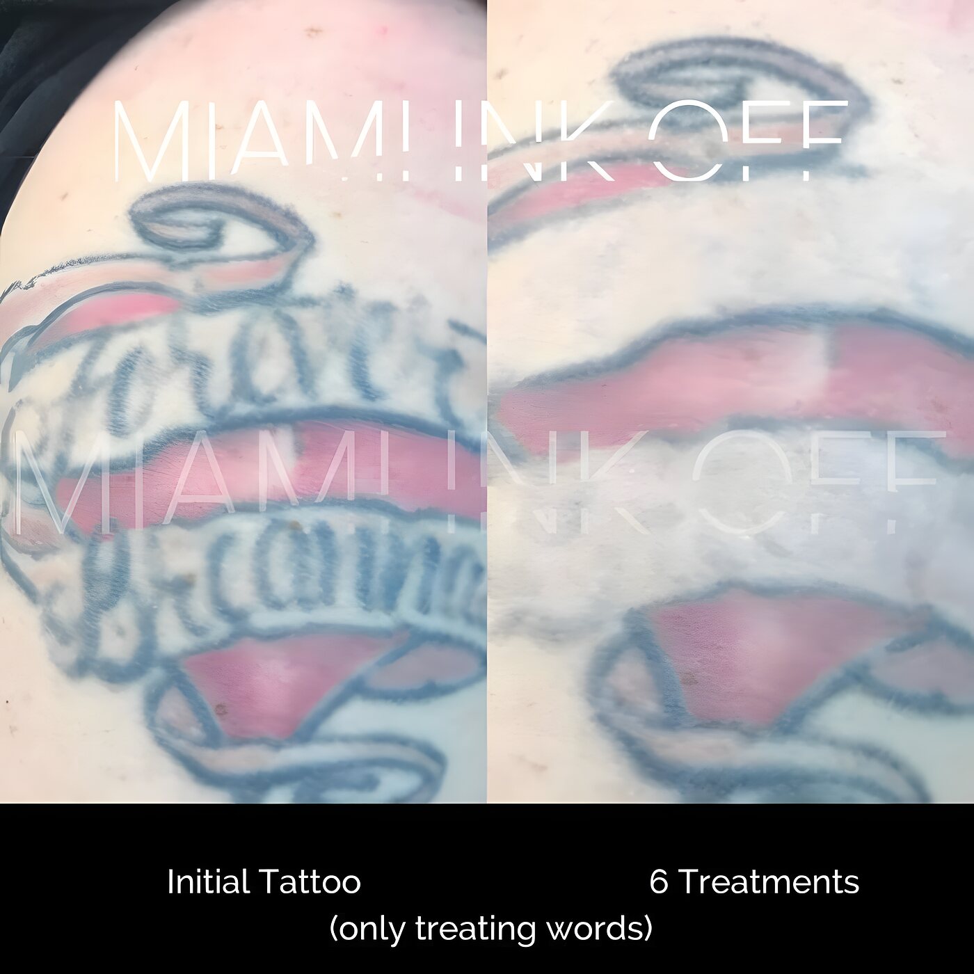 Selective laser removal of the words inside a banner tattoo after six sessions at Miami Ink Off, Brickell.