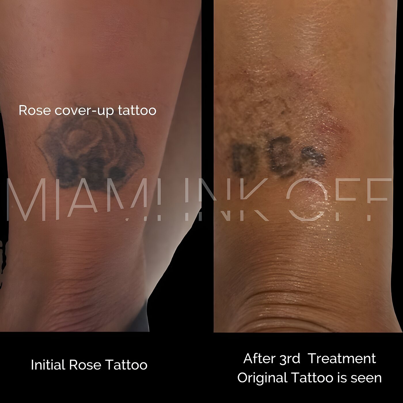Original tattoo revealed under a botched cover-up after three laser sessions at Miami Ink Off, Brickell.
