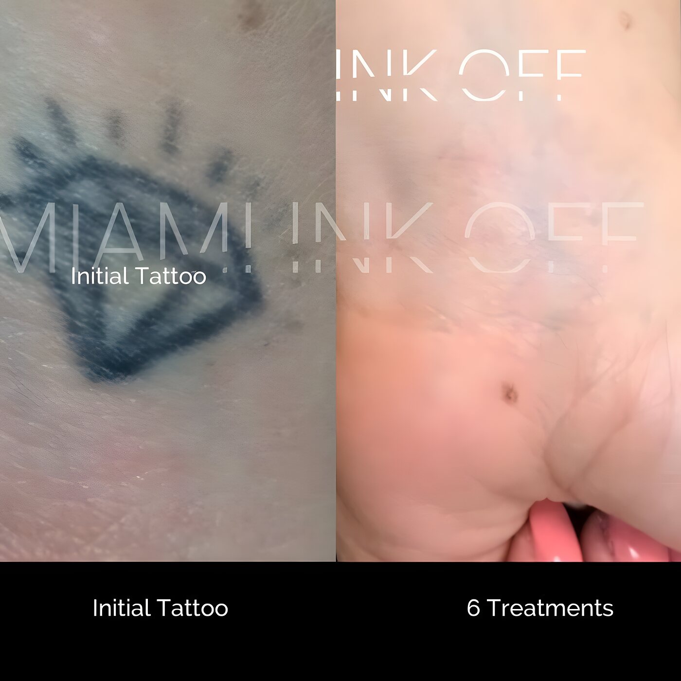 Diamond outline tattoo cleared after six laser tattoo removal sessions at Miami Ink Off, Brickell.