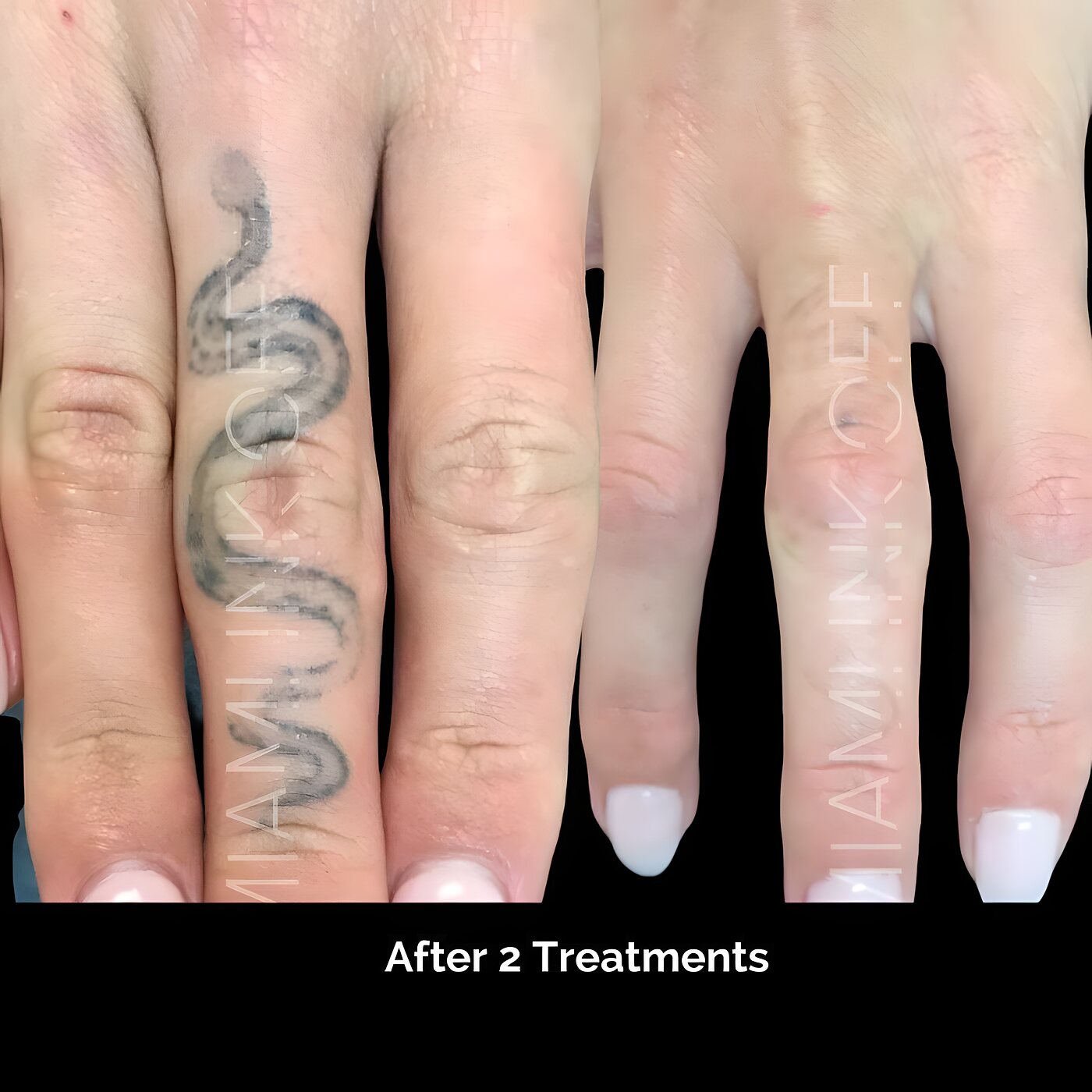 Finger snake tattoo nearly cleared after two laser tattoo removal sessions at Miami Ink Off, Brickell.