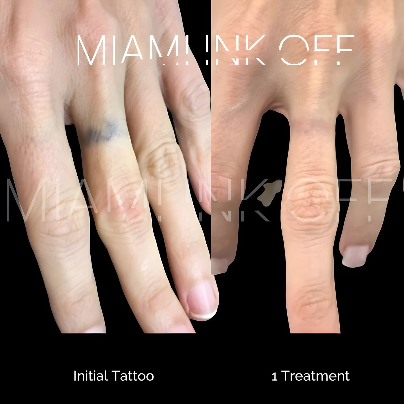 Tiny ring-finger tattoo removed after one laser tattoo removal session at Miami Ink Off, Brickell.