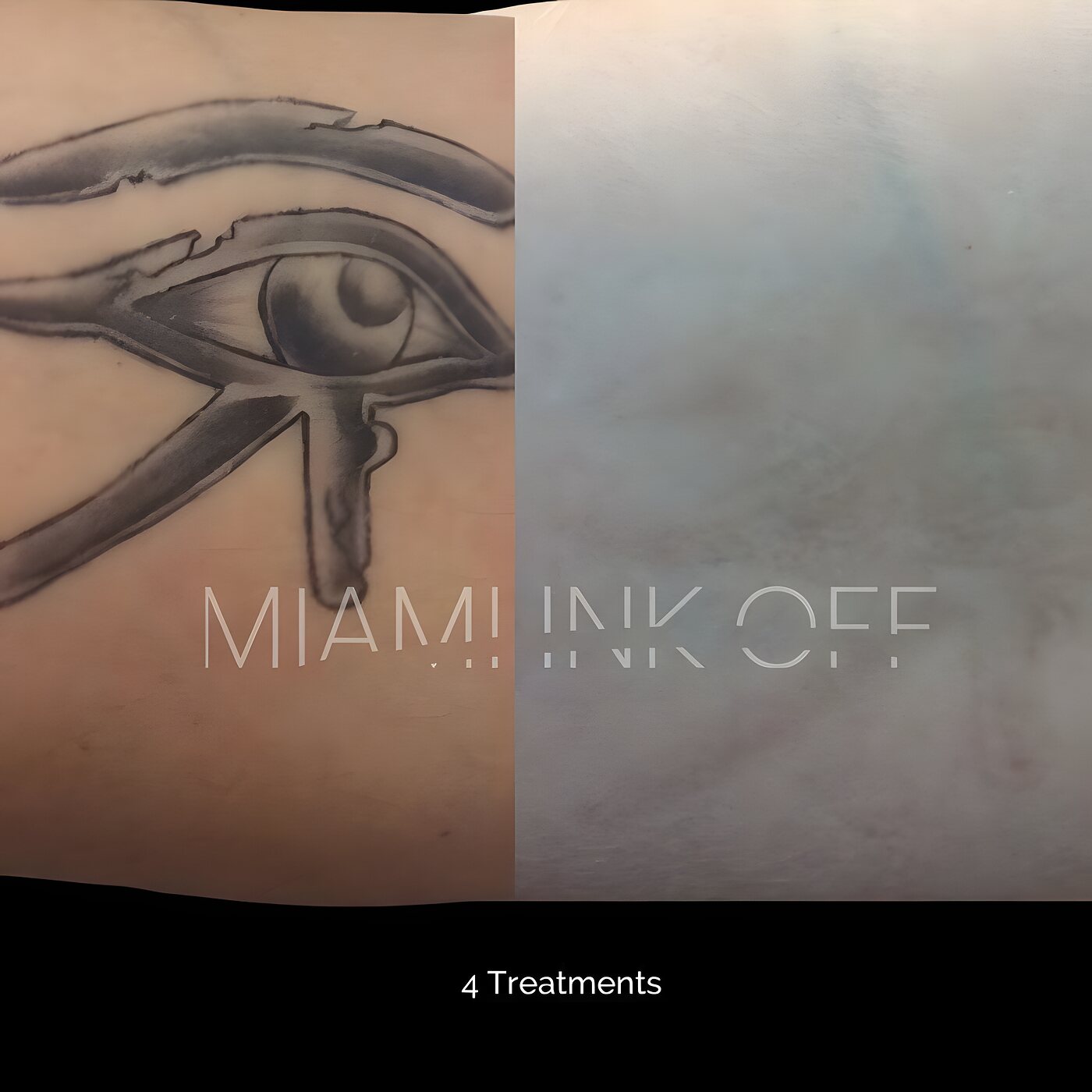 Eye of Horus forearm tattoo fully cleared after four laser tattoo removal sessions at Miami Ink Off, Brickell.
