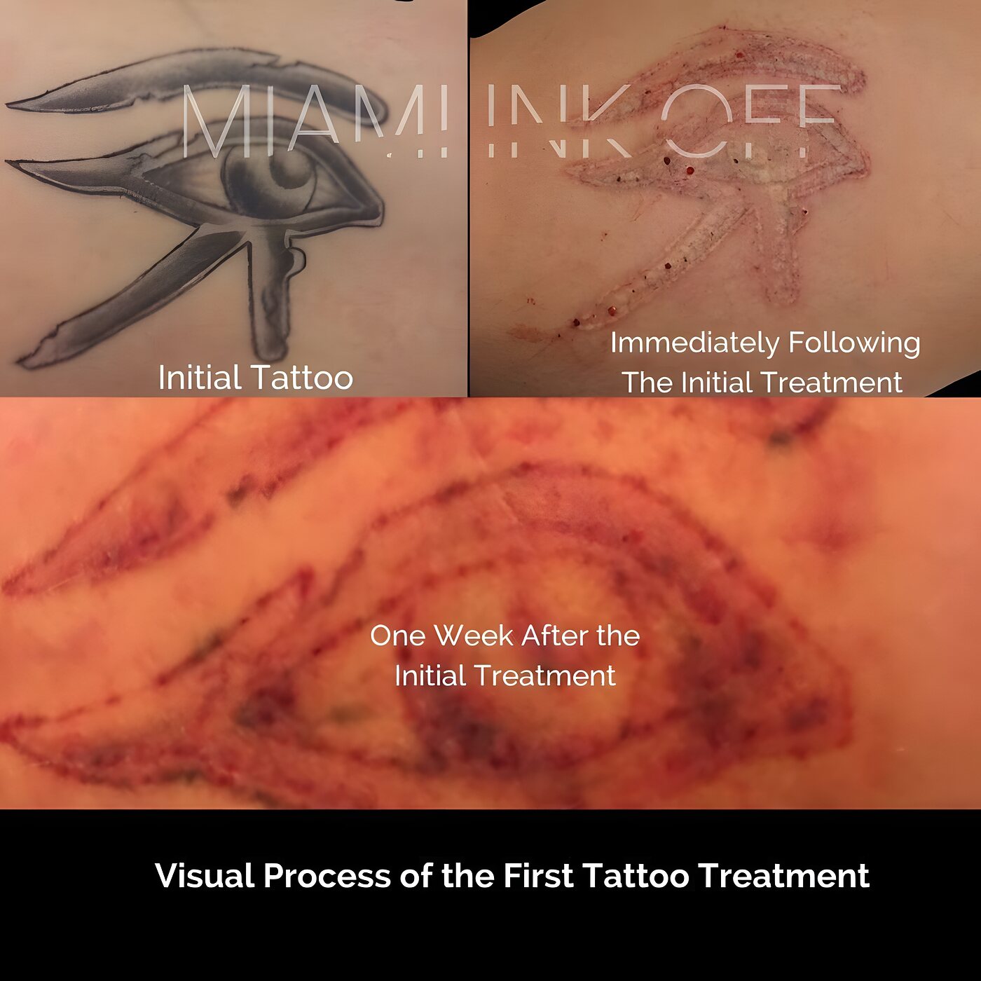 Laser tattoo removal healing process — before, immediately after, and one week later at Miami Ink Off, Brickell.